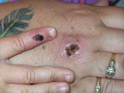 Monkeypox: Berlin records first cases of rare virus