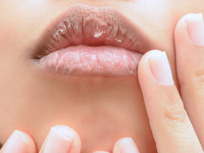 How to Avoid Chapped Lips This Winter, According to Dermatologists