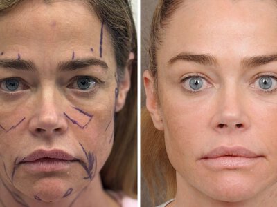 Denise Richards’ Unfiltered Facelift Before and Afters Are a Gift to Us All