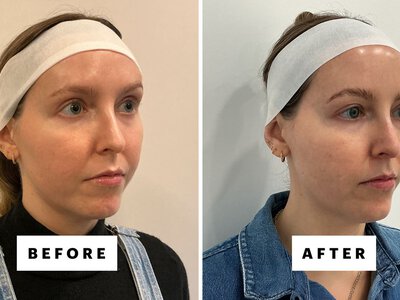 I Tried XERF, the New Korean Skin-Tightening Treatment All Over Your Feed
