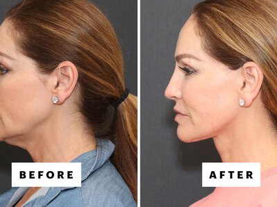 The Trending Procedure That Can Restore Your 25-Year-Old Jawline