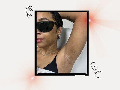 How I'm Preventing Hyperpigmentation During Laser Hair Removal