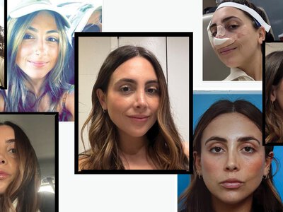 I Got a Revision Rhinoplasty to Fix My Nose Job