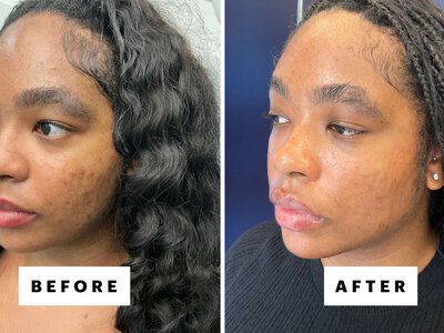 Why Black Women Are Choosing Laser Genesis as Their Skin Treatment of Choice