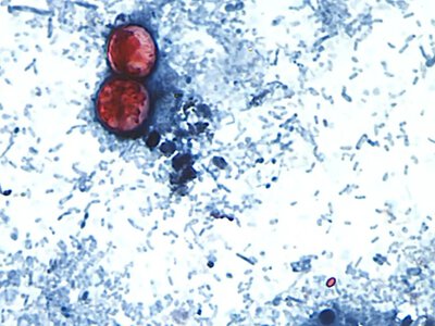An outbreak of the parasitic infection cyclosporiasis has spread to 31 US states, with the number of cases rapidly increasing