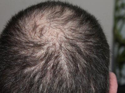 Weight loss drugs increase the risk of hair loss - study
