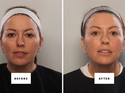 Can You Fake a Blepharoplasty? I Gave It My Best Shot