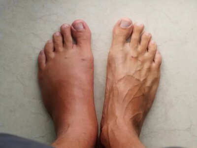 What to do in case of leg swelling — the best treatment methods