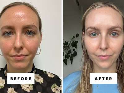 Are Azelaic Acid and Tretinoin Safe to Use Together?