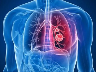 A new drug against aggressive lung cancer reduced the risk of death by 54%