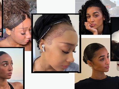Women Are Getting Hair Transplants in Turkey, Too