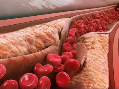 Scientists edited a gene and halved bad cholesterol – the effect has lasted for a year already